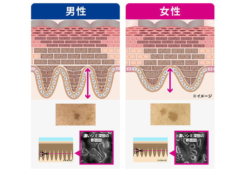 男性と女性のシミ構造(小林製薬Webサイトより)