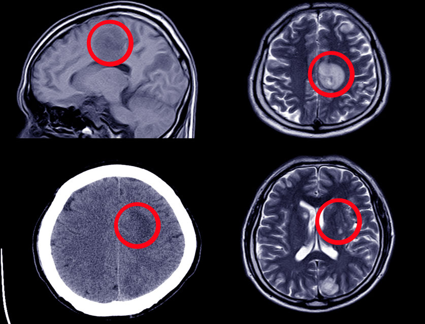 Accidente Cerebrovascular: Comprensión y Prevención-