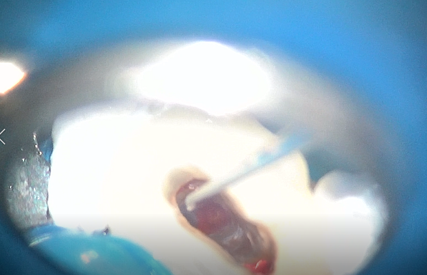 術中顕微鏡写真