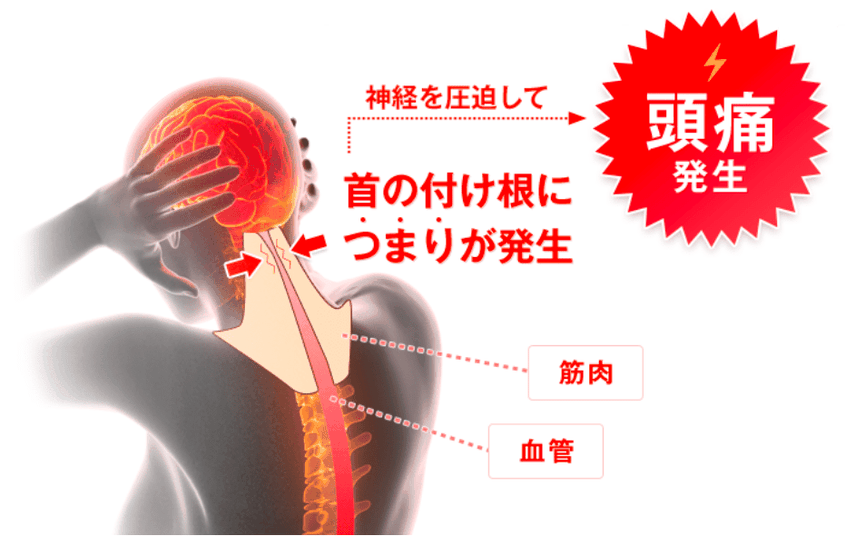 「頭痛」は、首のつけねの血行不良が原因 図