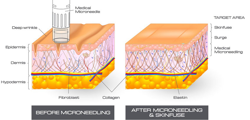 how microneedling works