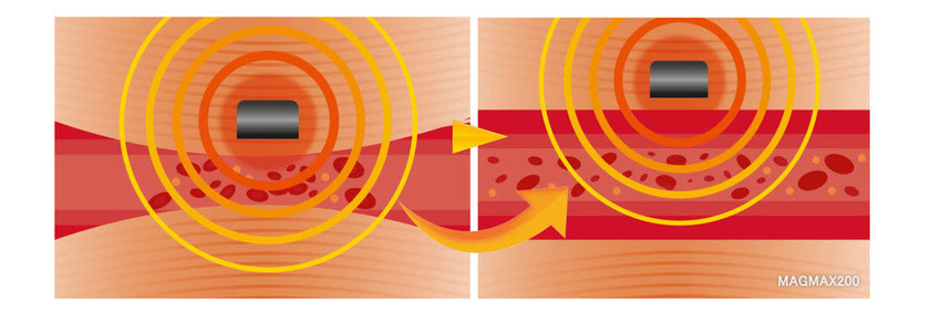 MAGMAX200｜200mT強力磁気が血行不良に直接働きかける