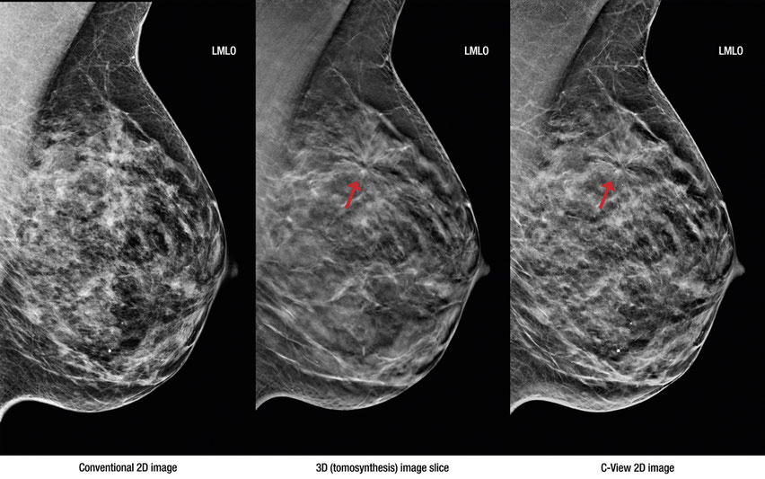 Mammographie und Tomosynthese Berlin moderne Brustdiagnostik Dr. Remschmidt, Tomosynthese