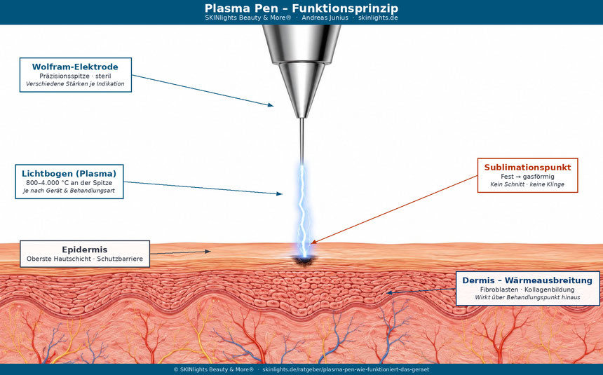Plasma Pen Funktionsprinzip – Lichtbogen zwischen Gerätespitze und Haut, Ionisierung, Sublimationspunkt, Hautschichten Epidermis Dermis