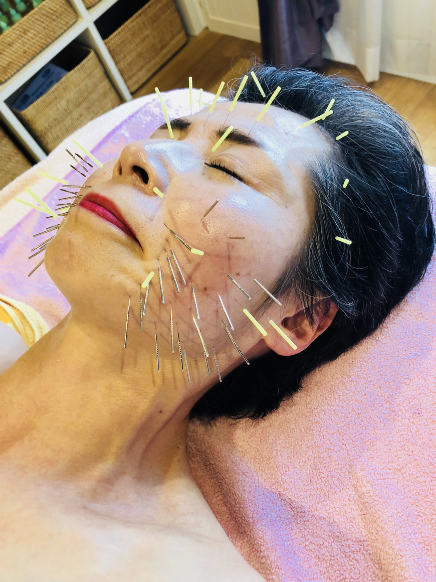 美容鍼灸