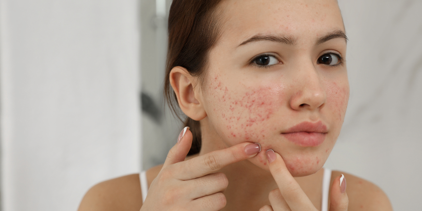 dermatillomanie
