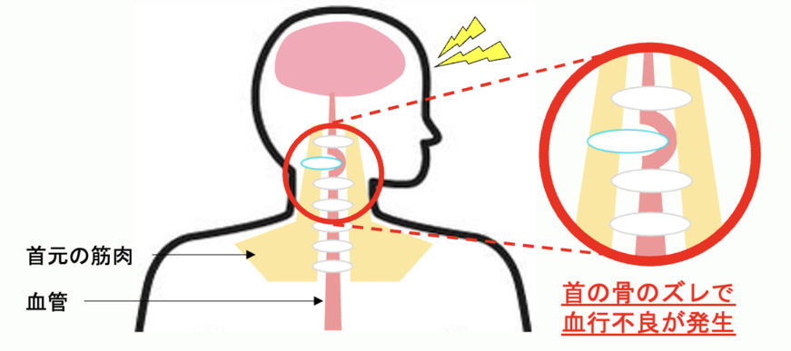 首の骨のズレで血行不良が発生　イラスト