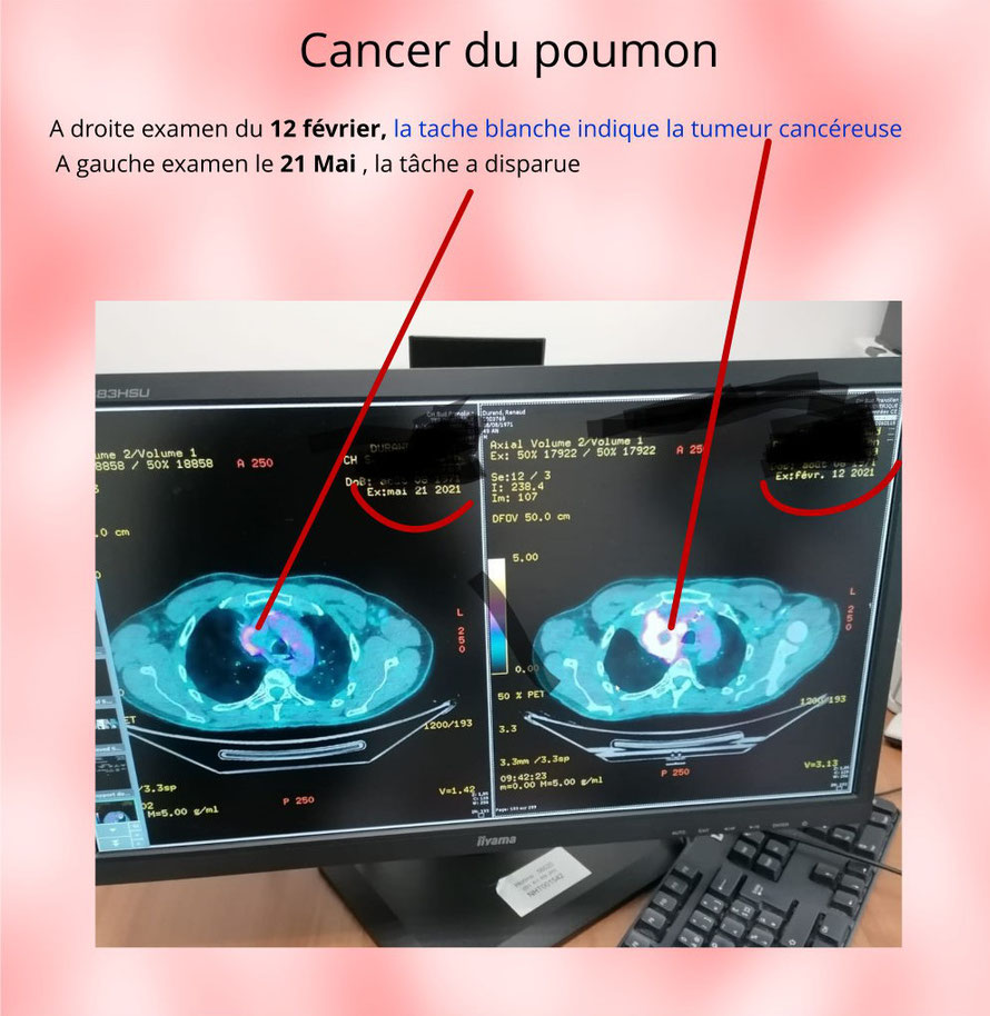 Guérison cancer du poumon stade 4 par magnétisme