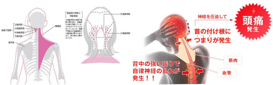 頭痛治療の施術内容