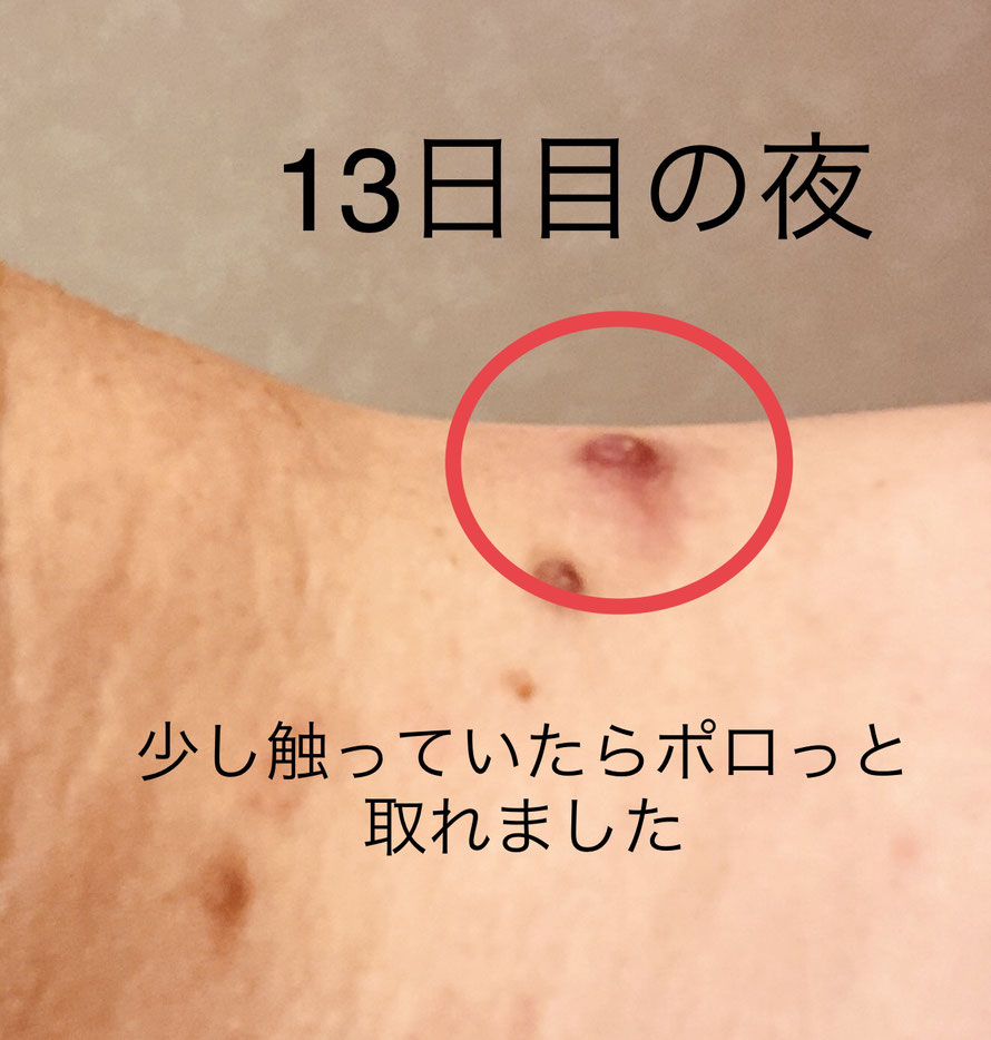 で 首 の イボ 取る 自分
