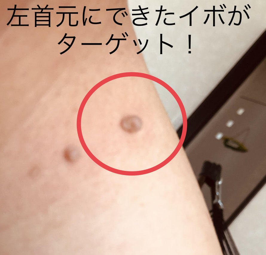 イボ ハサミ 首 首イボは除去できる？皮膚科での首いぼ治療について