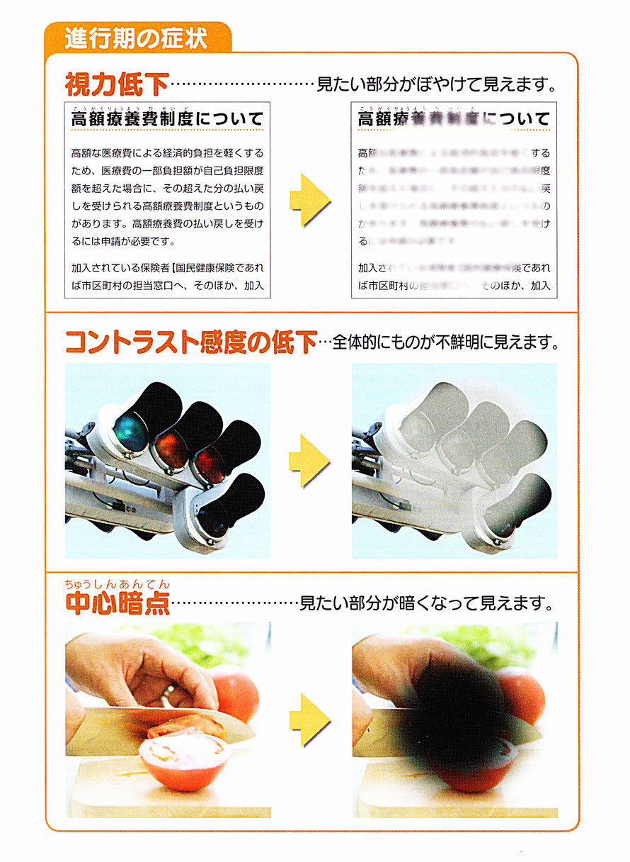 加齢黄斑変性症の進行期の症状の画像。視力低下、コントラスト感度の低下、中心暗点。