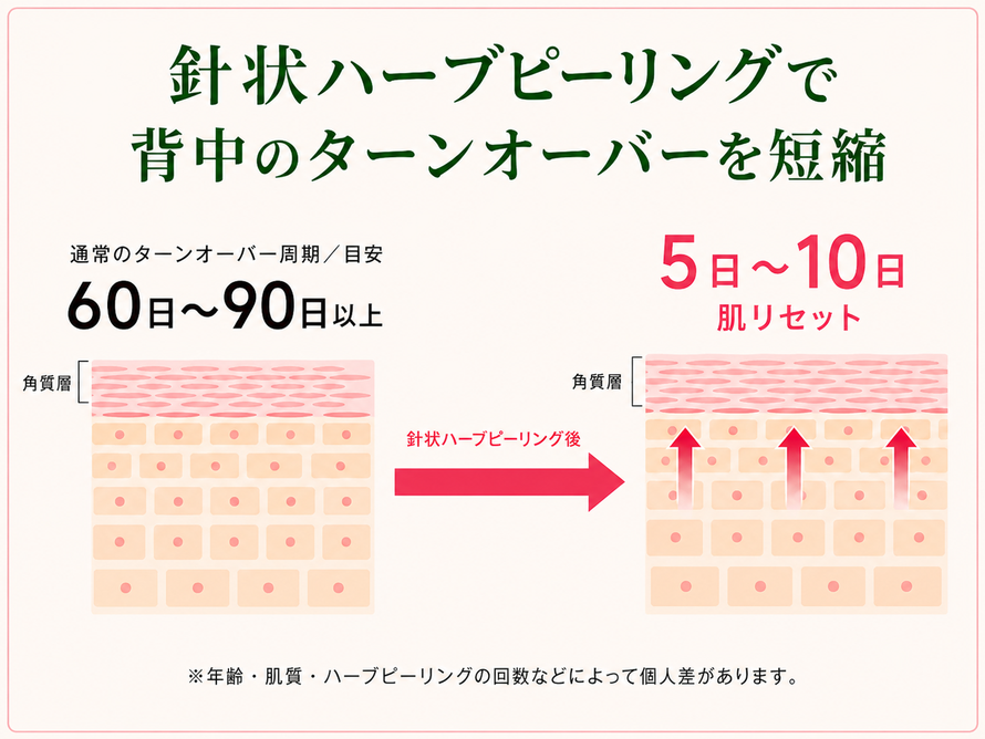 針状ハーブピーリングにより、通常60日～90日以上かかる背中のターンオーバーを5日～10日に短縮し、肌の生まれ変わりを早めます|札幌 背中ニキビ|エステサロン トゥインクル(Twinkle)