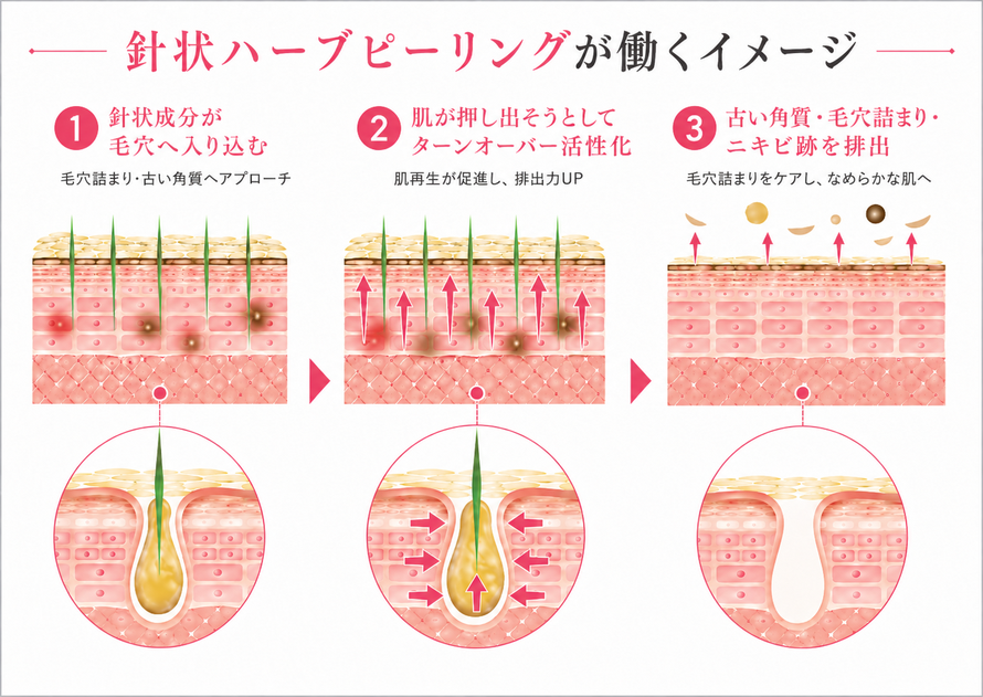 針状ハーブピーリングが働くイメージ ➀針状成分が毛穴に入り込む ➁肌が押し出そうとしてターンオーバー活性化 ③古い角質・毛穴詰まり・ニキビ跡を排出 | 背中ニキビ専門サロン 札幌エステ Twinkle(トゥインクル) 