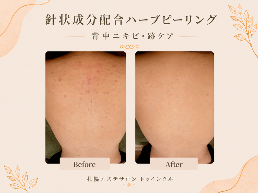 札幌 エステ 背中ニキビ専門サロン Twinkle(トゥインクル) | 背中ニキビ・ニキビ跡改善 | ビフォーアフター