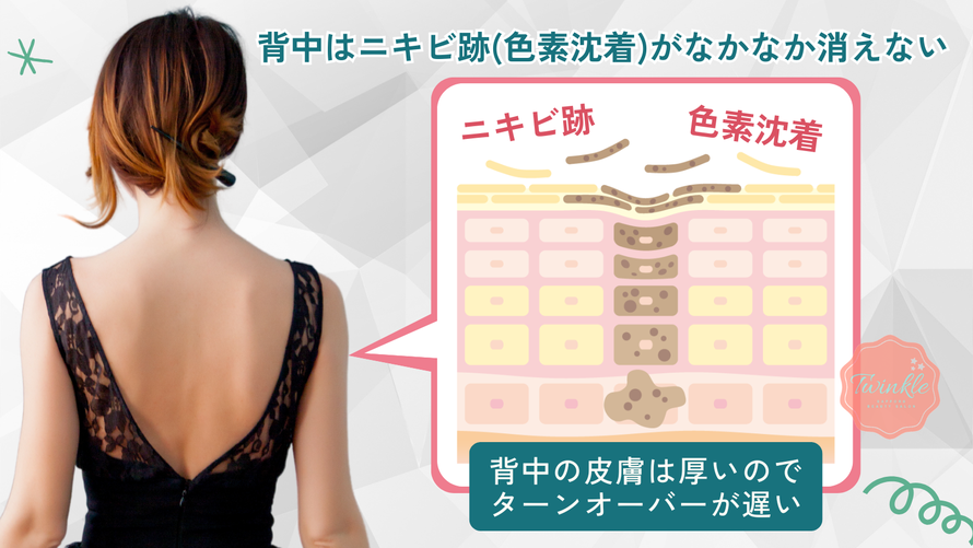 背中はニキビ跡(色素沈着)がなかなか消えない/背中の皮膚は厚いのでターンオーバーが遅い