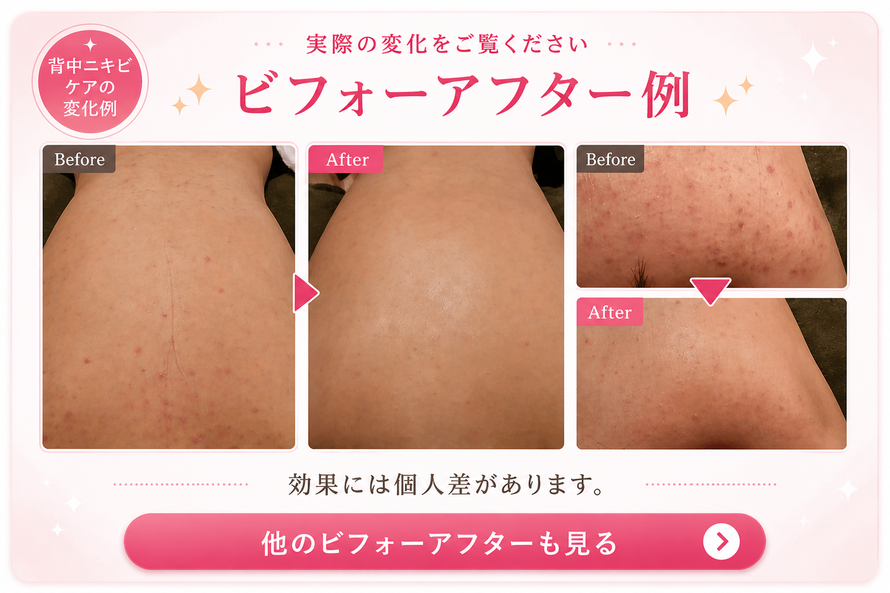 背中ニキビ専門サロン トゥインクル ビフォーアフター