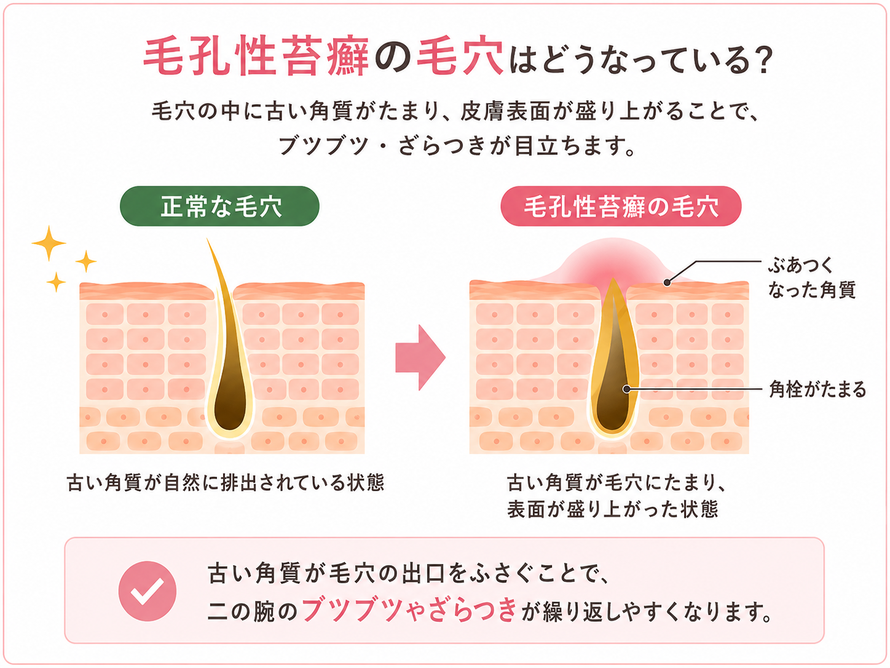 毛孔性苔癬の毛穴はどうなっている？｜ハーブピーリング｜エステサロン Twinkle(トゥインクル)