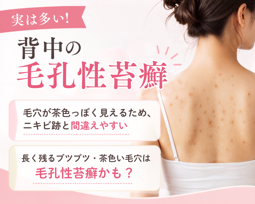 実は多い背中の毛孔性苔癬|背中ニキビ専門サロン|札幌エステ Twinkle(トゥインクル)