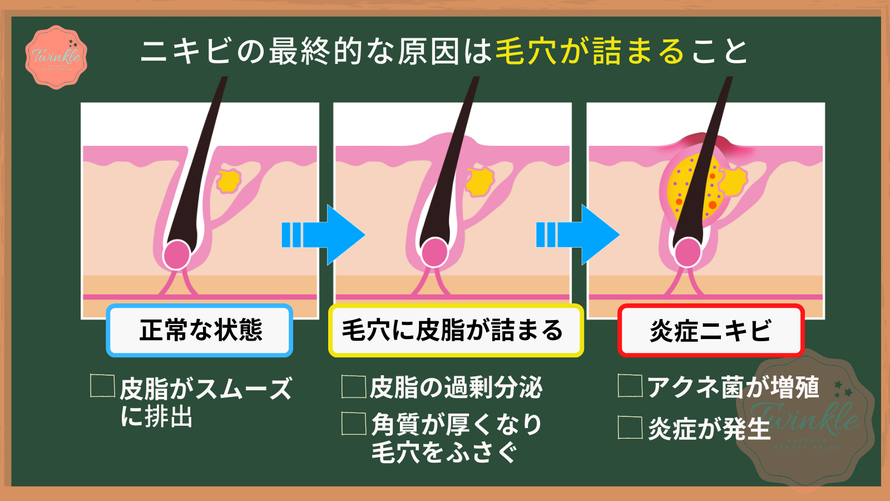 ニキビの最終的な原因は毛穴が詰まること/ニキビ発生のメカニズム
