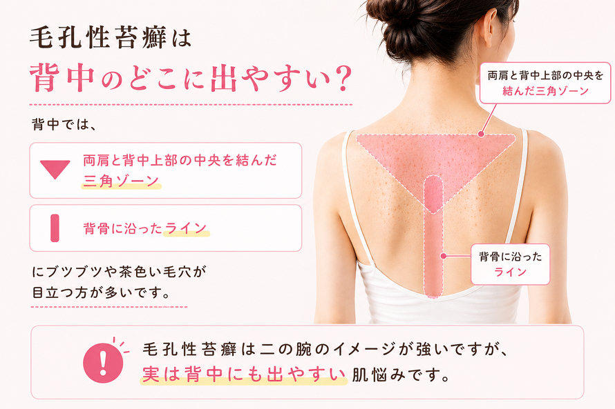 背中の毛孔性苔癬が出やすい部分|札幌 背中ニキビ|エステサロン トゥインクル(Twinkle)