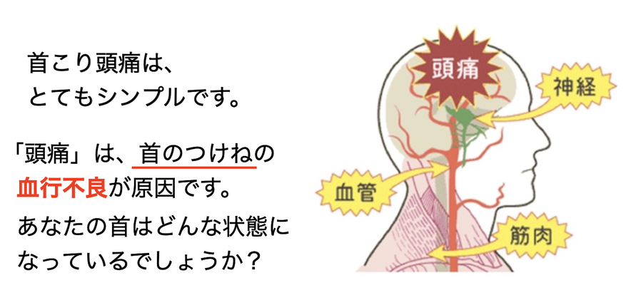 首こり頭痛は、とてもシンプルです。「頭痛」は、首のつけねの血行不良が原因です。あなたの首はどんな状態になっているでしょうか？