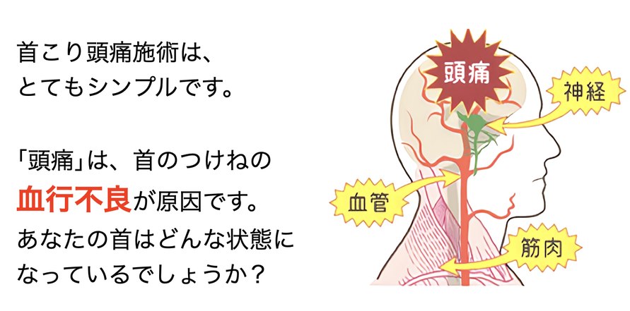 首こり頭痛施術は、とてもシンプルです。頭痛は首のつけねの血行不良が原因です。あなたの首はどんな状態になっているでしょうか？