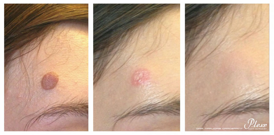 Blefaroplastia sin cirugía