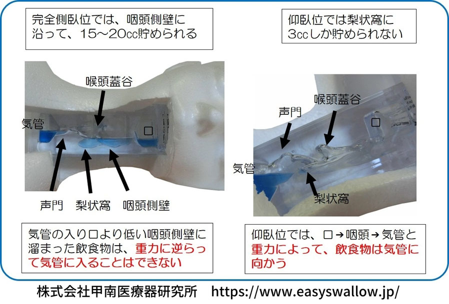 のどの中は重力によって、完全側臥位では誤嚥できなきが仰臥位は誤嚥リスクがともなう