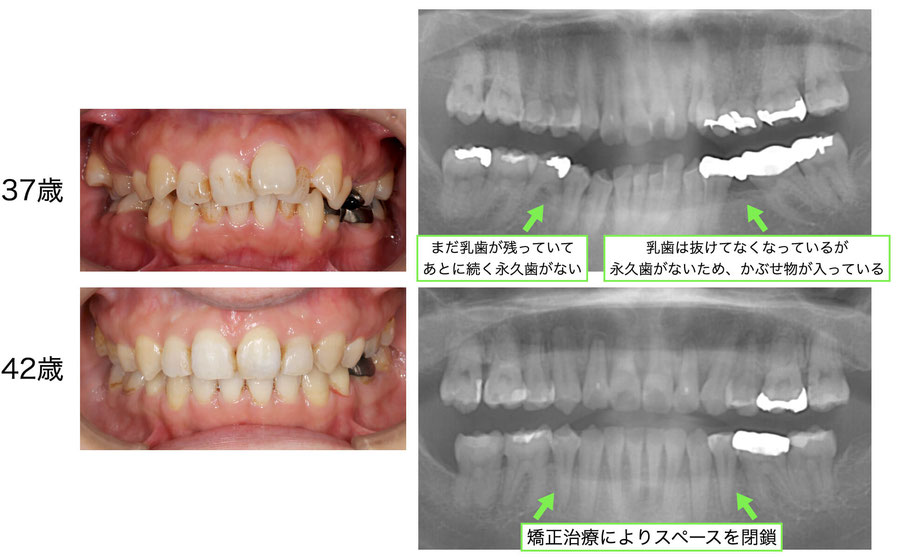 やみか歯科・矯正歯科　先天性欠如　矯正で閉鎖　症例