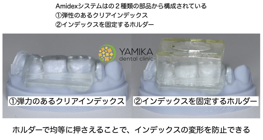 Amidex歯科　やみか歯科・矯正歯科　ダイレクトボンディング
