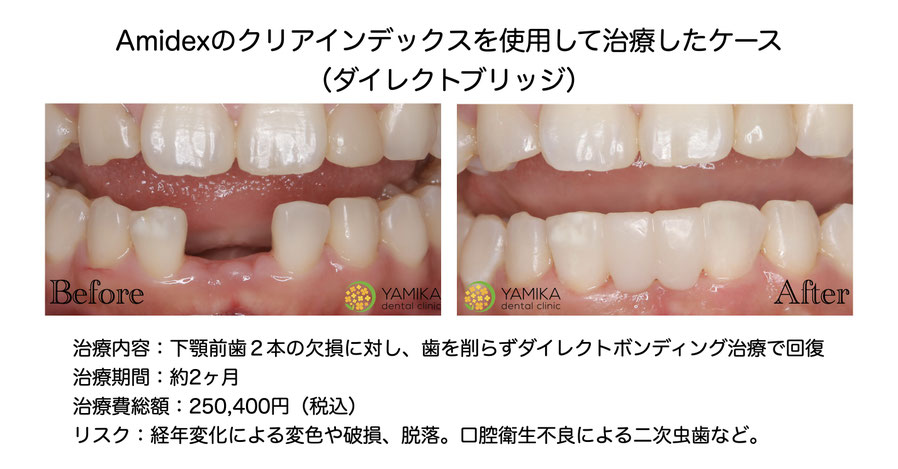 やみか歯科・矯正歯科　ダイレクトボンディング　Amidex　ダイレクトブリッジ