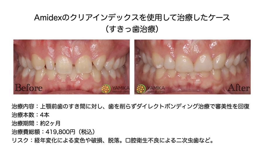 やみか歯科・矯正歯科　ダイレクトボンディング　Amidex　すきっ歯治療