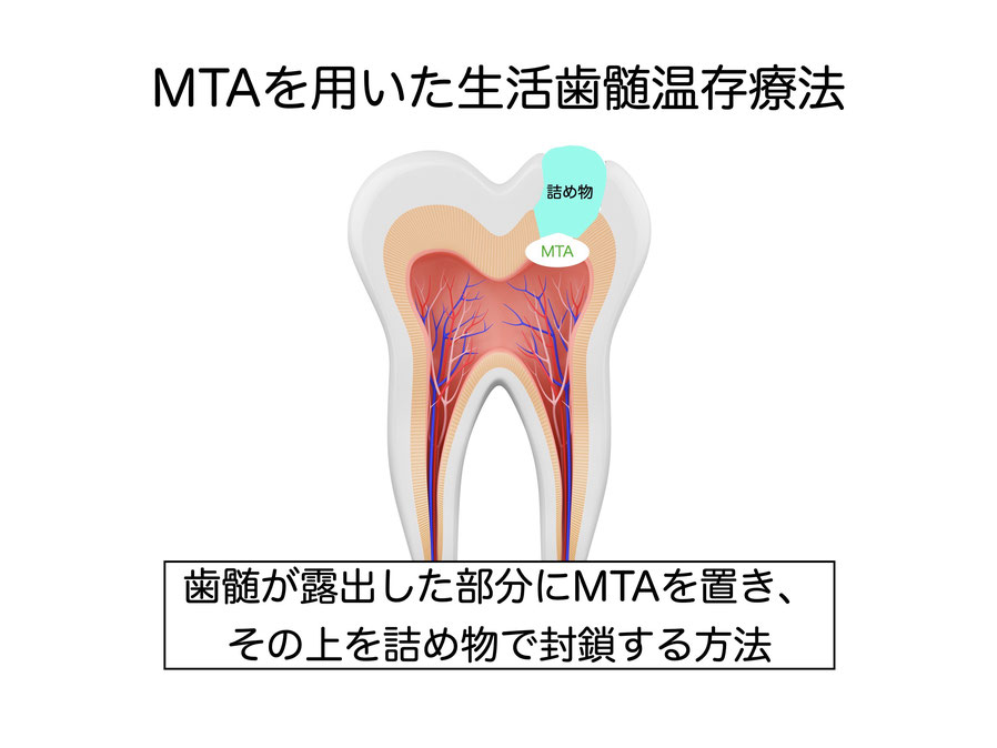 やみか歯科・矯正歯科　生活歯髄温存療法　神経を取らない治療　MTA