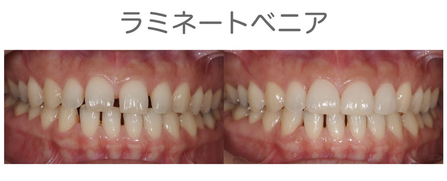 やみか歯科・矯正歯科　ラミネートベニア　すきっ歯（空隙歯列）の治療