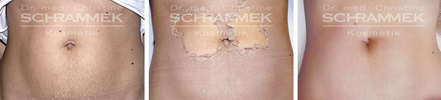 PermanentMakeUp Haarentfernung Wimpernlifting Gesichtsbehandlung Antiaging Needling BIOPeel Microblading Microdermabrasion LPGEndermologie Aknebehandlung Gesichtsbehandlung LPG Pedicure Shellac Manicure Akne Pedicure Sofri Akne LPG Greenpeel Microneedling