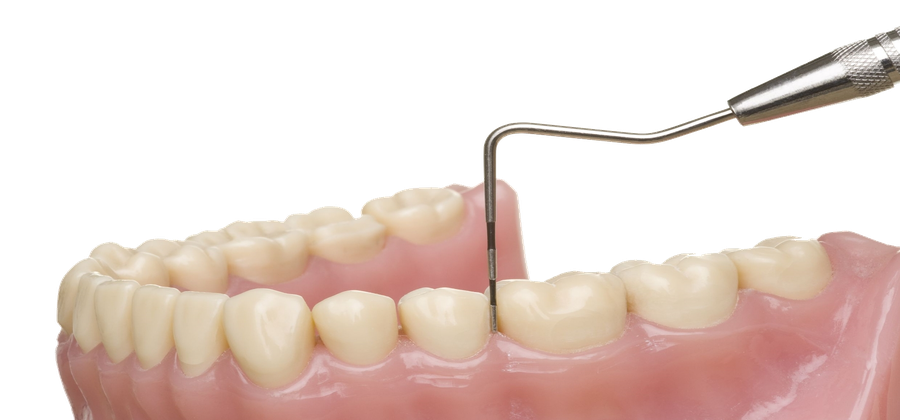 Parodontose Heute Laser Gegen Bakterien Zahnarzt