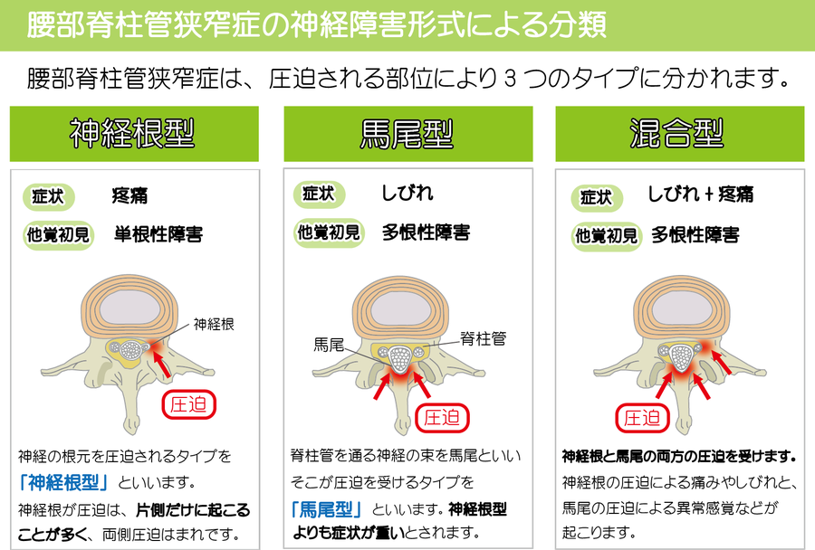 腰部脊柱管狭窄症3つのタイプの画像