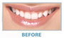 Zähne vor Lumineers und Veneers | SOS Zahnärzte