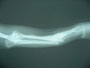 血行が悪い部分なので受傷２週間は腫れもしませんでした。１ヶ月後から骨の融解が始まりました。元気すぎて曲がってしまいましたがこのままいくことにしました。写真は1.5ケ月近く