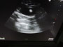 超音波診断での画像。デジカメでデイスプレーを撮影したので粗い画像に写っています。黒い部分が膀胱内、丸く映っているのが結石。下はウンチ。
