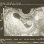 Ultraschall in der 12. SSW