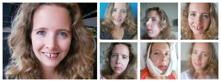 Collage kaakverbreding