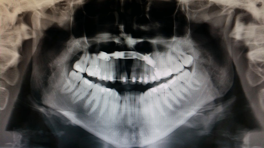 X-ray TPD-schroef