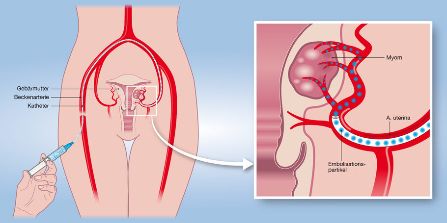 Embolisation Myom