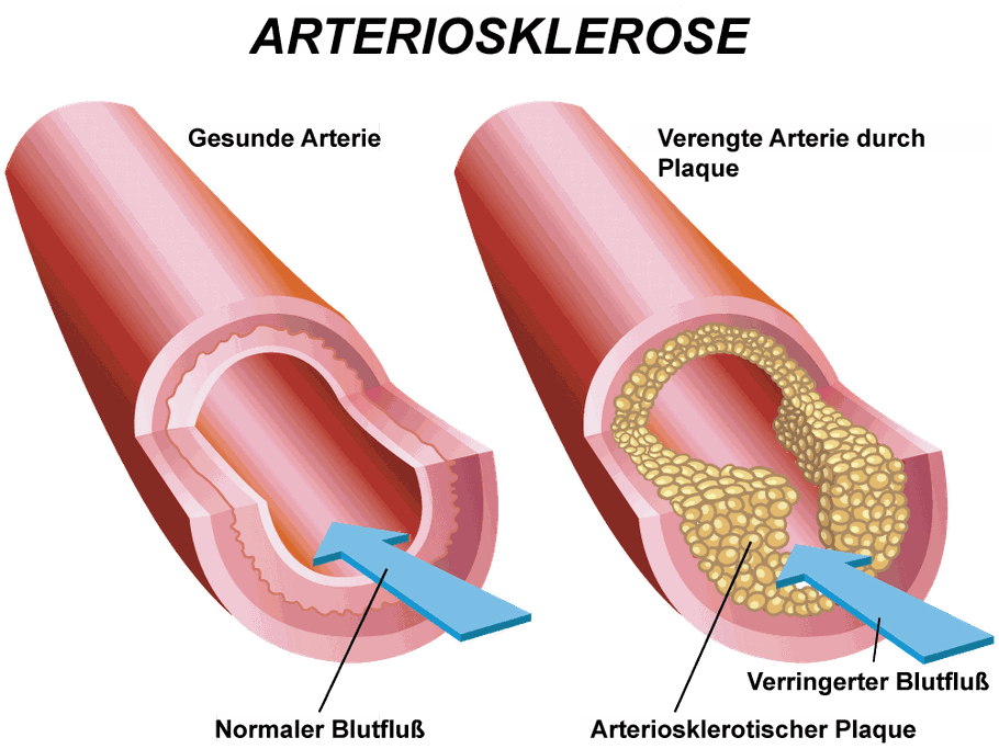 Bild: Entstehung der Arteriosklerose