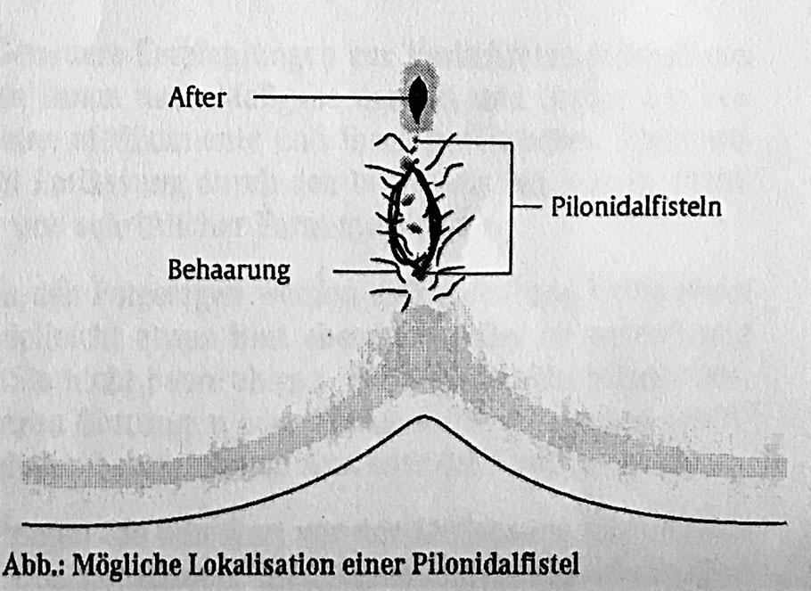 Operation mit offener Wundheilung Sinus Pilonidalis