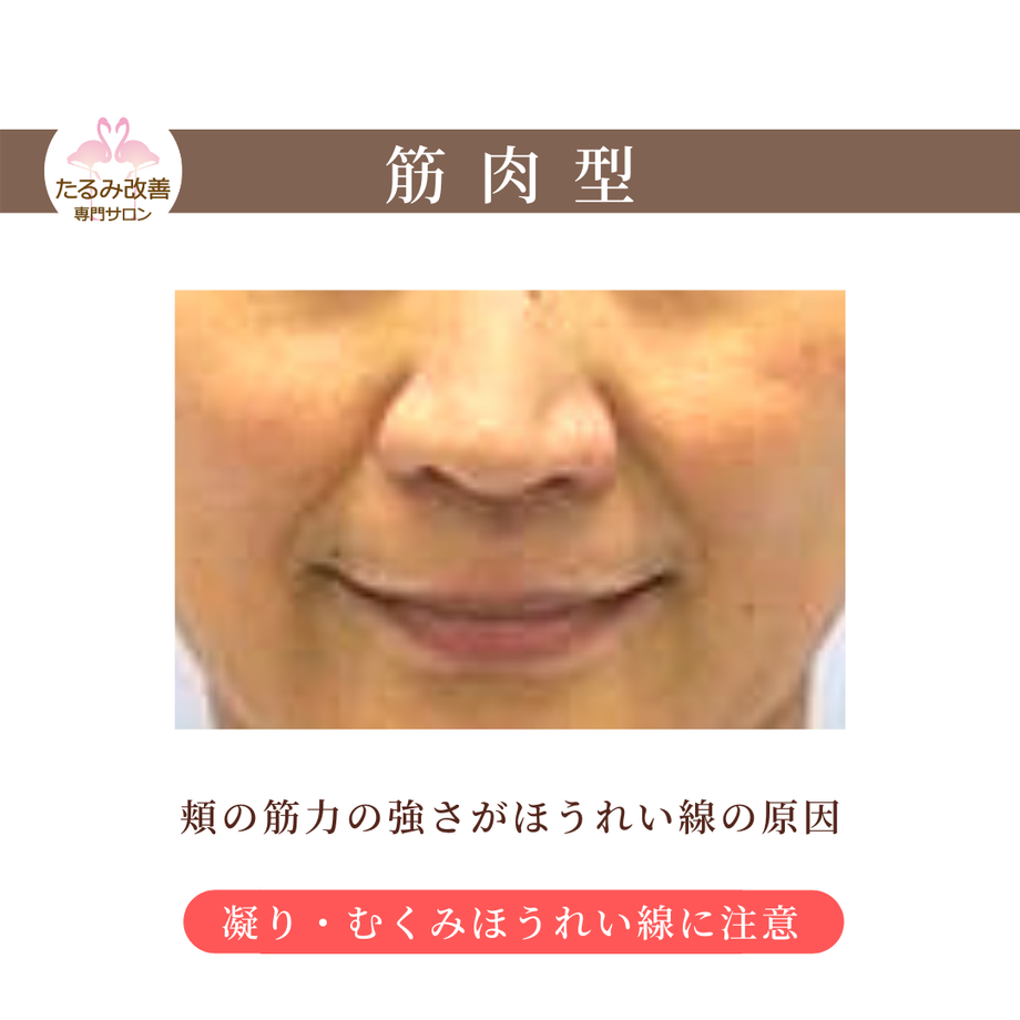 あなたのほうれい線は何由来？異なるタイプのほうれい線 豊橋のたるみ改善専門サロン ポルト・ボヌール