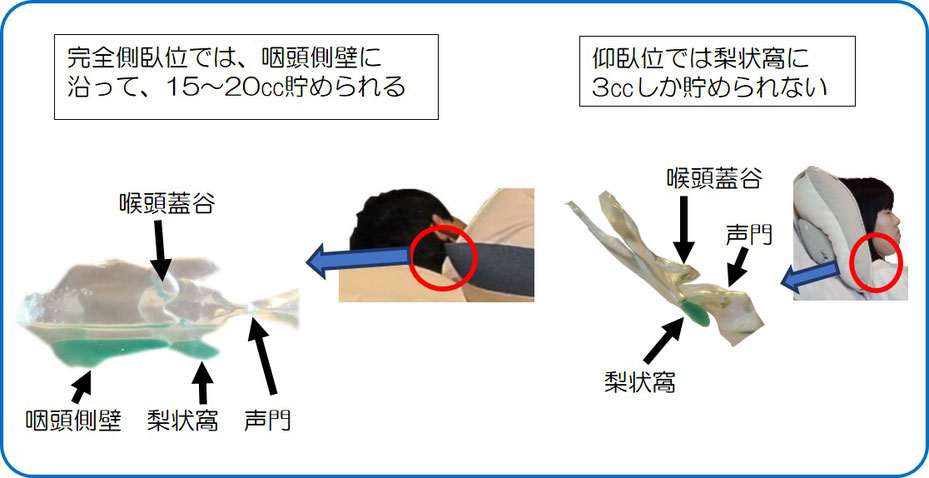 完全側臥位と仰臥位との比較