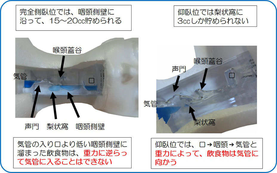 喉にある飲食物は、完全側臥位では重力に逆らって気管に入れない。仰臥位では重力によって気管に向かう